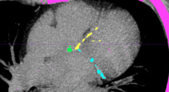Coronary artery calcium scores. Should I get one?